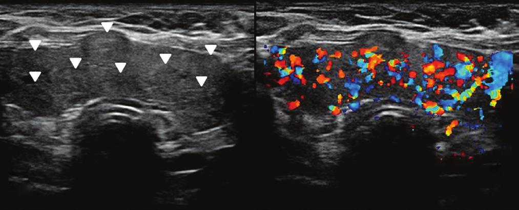 Trnsverse gry-scle ultrsound () nd color Doppler () neck, of 55-yer-old femle ptient, revel well-circumscried right-sided thyroid nodule (rrow) with lrge intrtumorl cyst nd solid peripherl component