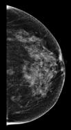 viable screening adjunct to mammography in