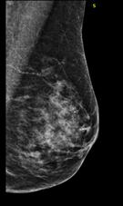 Compare MBI and mammography in asymptomatic