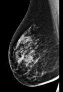 mammography Screening Mammogram 2 cm IDC MBI