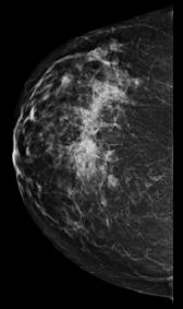 Can MBI find lesions not visible on mammography? Can MBI find lesions not visible on mammography? 1.1cm nodular density in upper inner right breast 9.