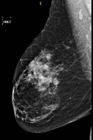 patients - asymptomatic Compare MBI and mammography in patients with dense breasts at increased risk of breast cancer MBI performed with 20 mci Tc-99m