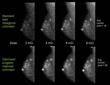 collimator Square holes Each hole matched to individual pixel on CZT detector Factor of ~2 gain in sensitivity expected Molecular Breast Imaging Effect of Optimal Collimation CZT Detector MBI