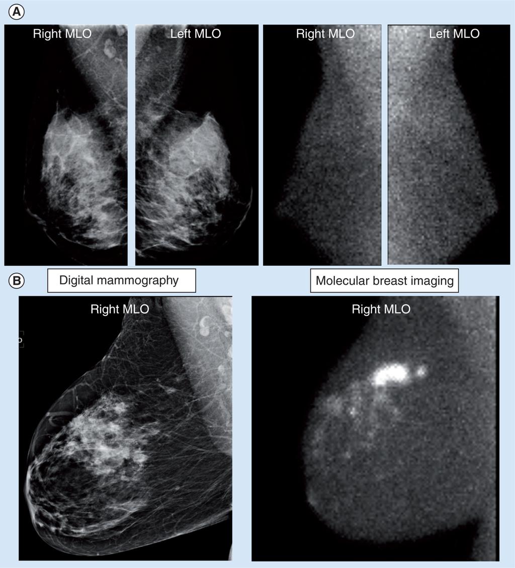 O'Connor et al. Page 12 Figure 2. (A) Right and left MLO views obtained by digital mammography and molecular breast imaging (MBI) in a normal subject.