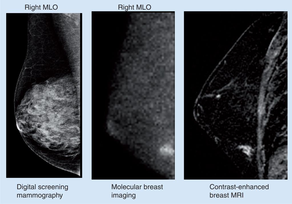 O'Connor et al. Page 13 Figure 3. Right MLO views obtained by digital mammography, molecular breast imaging and contrast-enhanced MRI Screening mammogram was interpreted as negative for disease.