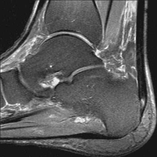 Achilles Tendon Tears Lower extremity malalignment Hyperpronated or cavus foot Forefoot varus FSE PD FS DS Heckman.