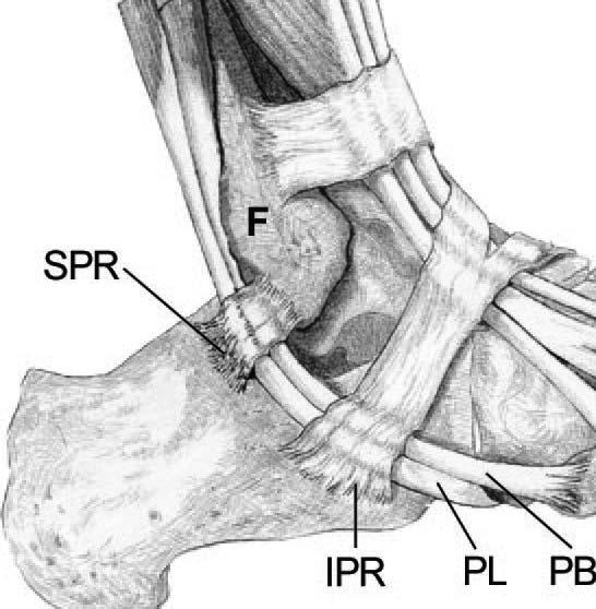 Retinacular stripping, peroneal split tear and subluxation PD Cerrato RA et al. Peroneal tendon tears, surgical management and its complications. Foot Ankle Clin.