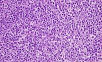 primary nodal B-cell neoplasm that