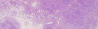 Nodal MZL Lymphoplasmacytic Lymphoma/ Waldenstrom