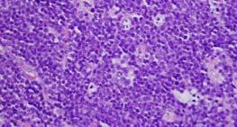 B-cell lymphoma High-grade B-cell lymphoma (Burkitt-like)