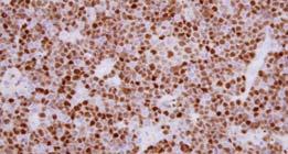 transformation Plasmablastic lymphoma Hodgkin-like CD30+