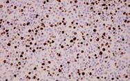 IHC Often negative for t(14;18)/igh-bcl2 Pediatric Type Age: 15-18y 10 M to 1 F No