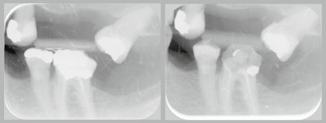 This image is ranked very low due to the two smallest dental work contours in the leftmost image being very different from the merged dental work in the rightmost image.