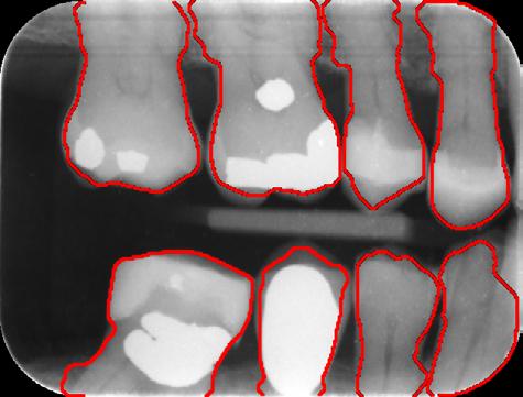 Tooth contours, however, require separating the image into single tooth images before contour extraction.