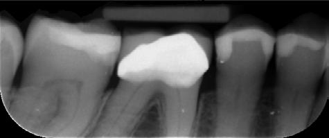 Such filters are commonly used to enhance images by removing un- even brightness [6] and more specifically as an enhancement method for dental X-rays as proposed by Zhou and Abdel- Mottaleb [5].