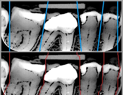 The problem of finding dark areas between teeth and jaws can then be formulated as a lowest cost graph search problem.