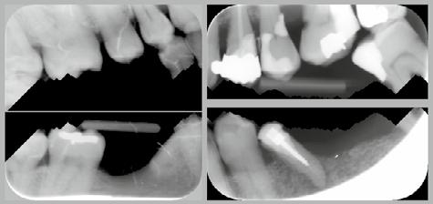 Correct and incorrect jaw separation using the path-based method. The intensity projection method was able to separate 92 of the 100 images correctly.