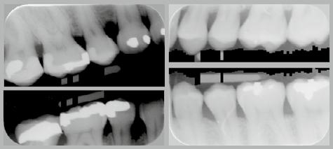 This can happen when the jaws are at an angle in the image or when the crowns of the teeth are touching.