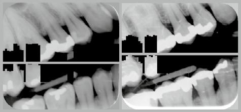 Although the intensity projection method allows the sepa- ration to be curved, it is limited, and in some cases where teeth are missing it can be initialized at the wrong point and fail to separate