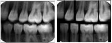 If thresholding is performed on the image before using the strip method, this problem can be avoided when the tooth is darker, but not when there is a gap between teeth. a) Correct b) Incorrect Fig.