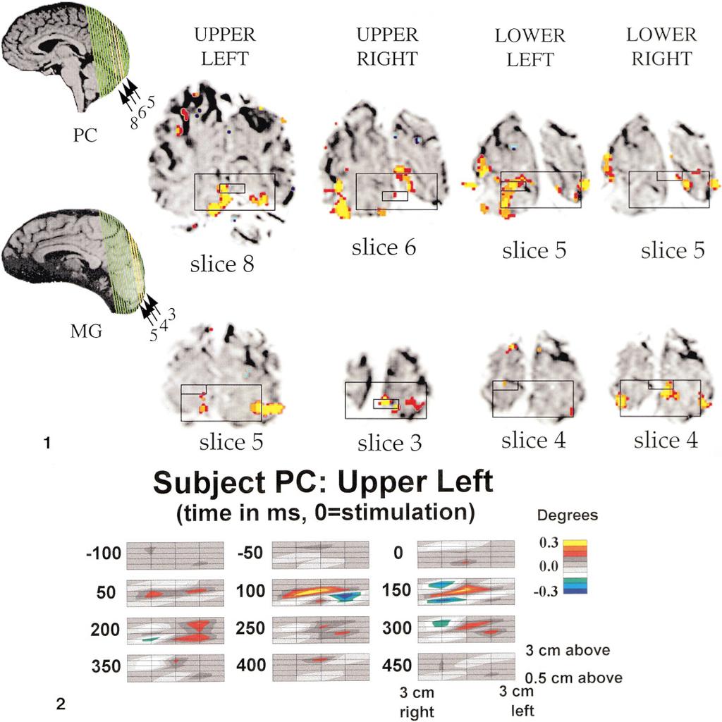 172 GRATTON ET AL. FIG. 1. The fmri responses (yellow, red, orange) and optical responses (small rectangles) are superimposed on these images.
