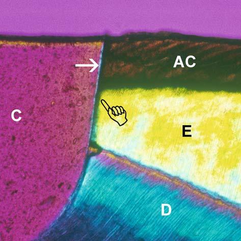10 F.R. Tay D.H. Pashley Fig. 1.5. Polarized photograph of the resin enamel interface in Single Bond (3 M ESPE) after artificial caries challenge in the absence of adjunctive fluoride protection.
