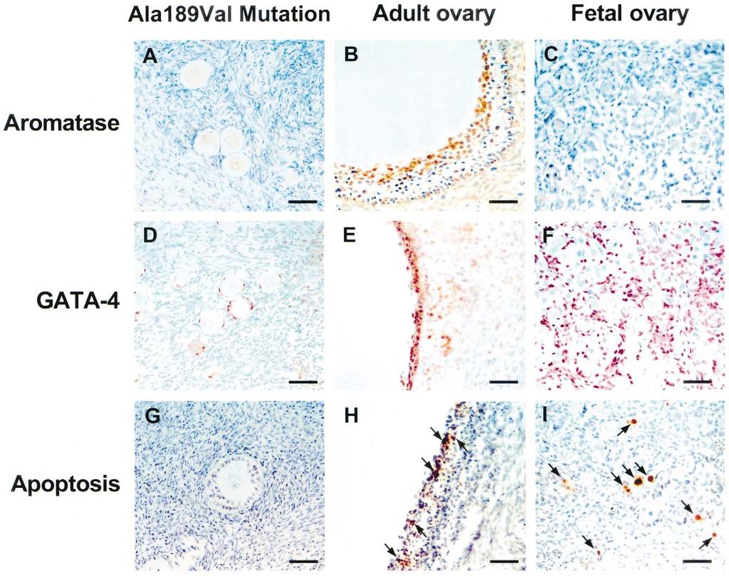 FIGURE 1 Aromatase cytochrome P450 and GATA-4 expression, and apoptosis in ovarian tissue from individuals with the Ala189Val FSH receptor gene mutation and from normal adult and fetal ovarian tissue.