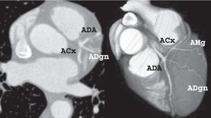 (Cx). Note the course of the circumflex artery in the left atrioventricular sulcus.