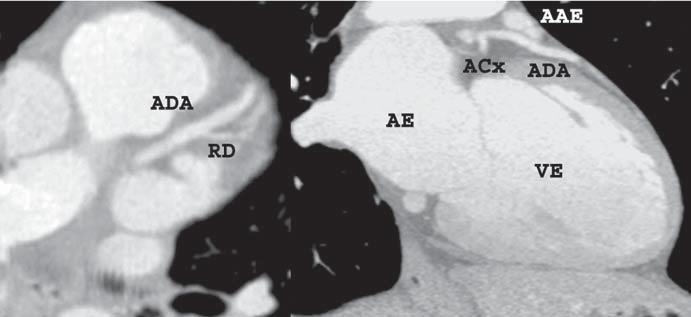 xial and oblique () and 3D volume rendering () reformatations demonstrating diagonalis artery (Dgn) originating from the left coronary