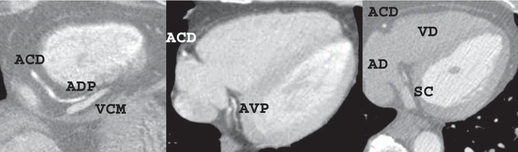 anterior interventricular sulcus, at the level of the first diagonal branch origin, and the right coronary artery (CD) in the right atrioventricular sulcus.