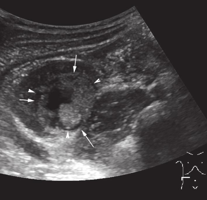 2 (a) (c) (b) (d) Figure 1: Case 1: male, 12 years old; a hyperechoic mixed mass was found in his right renal of lower part in the renal medulla.