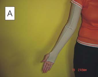 This type of sleeve achieved the same results as were seen using inelastic dressings. Several Advantages can be seen when the sleeve is compared with the traditional inelastic dressings.