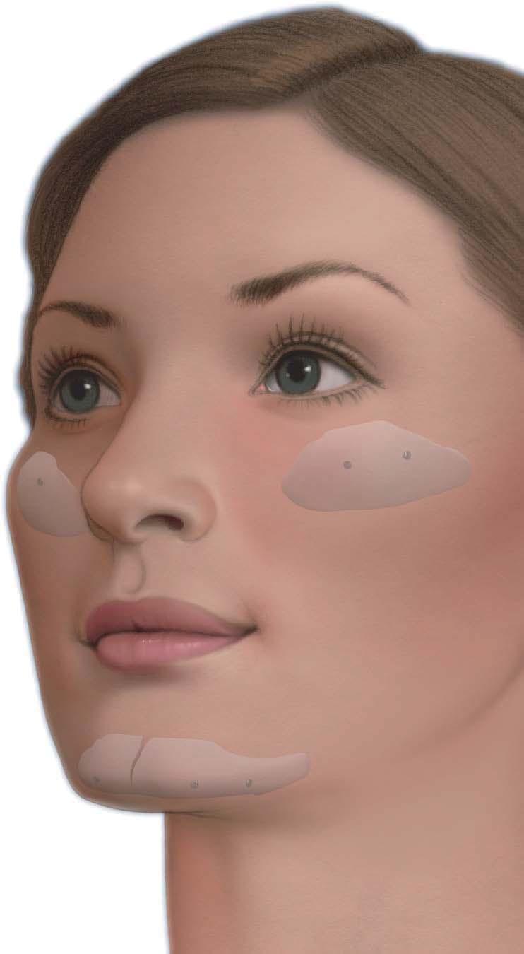 SYNPOR HD FACIAL SHAPE SYSTEM For the augmentation or