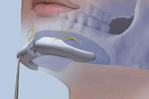 Registration tabs positioned at the inferior border of the implant assure that the implant is aligned with the inferior border of the mandible and lessens the possibility of impingement on the mental
