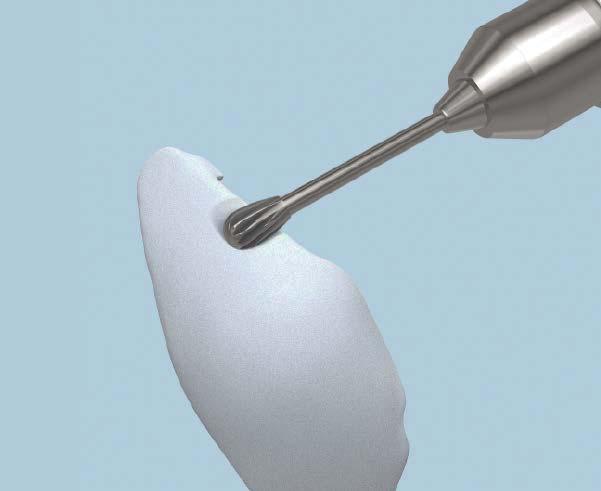 However, implants can be easily trimmed and contoured with a scalpel or high speed burr to suit the individual needs of the patient.