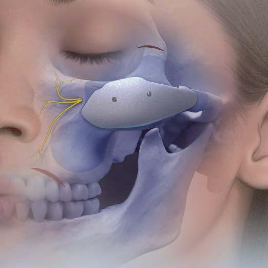 Screw fixation immobilizes the positioned implant and eliminates any gaps between the inner surface of the implant and the surface of the facial skeleton.