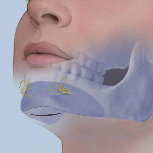 Surgical Technique: Chin 1 Approaches Chin implants can be placed through intraoral or submental approaches. The area for desired augmentation should be exposed by subperiosteal dissection.