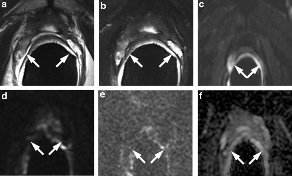 a Axial T2-weighted fast spin-echo (5170/112), b axial T2-weighted fat saturated fast spinecho (6920/112) and c sagittal T2-weighted fast spin-echo (4730/114) image showing a hyperintense lobulated