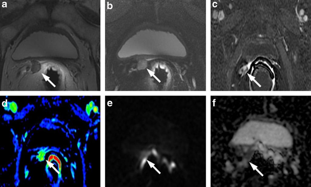 624 Insights Imaging (2015) 6:611 630 Fig. 19 MR images of a 68-year-old man with prostate-specific antigen progression (PSA serum level 0.
