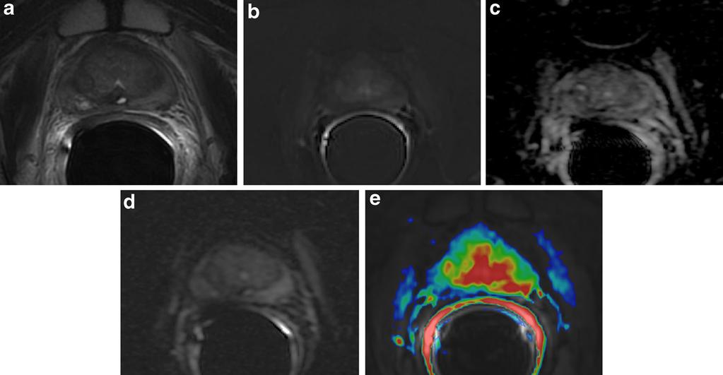 Insights Imaging (2015) 6:611 630 625 Fig. 21 Post-RT treatment.
