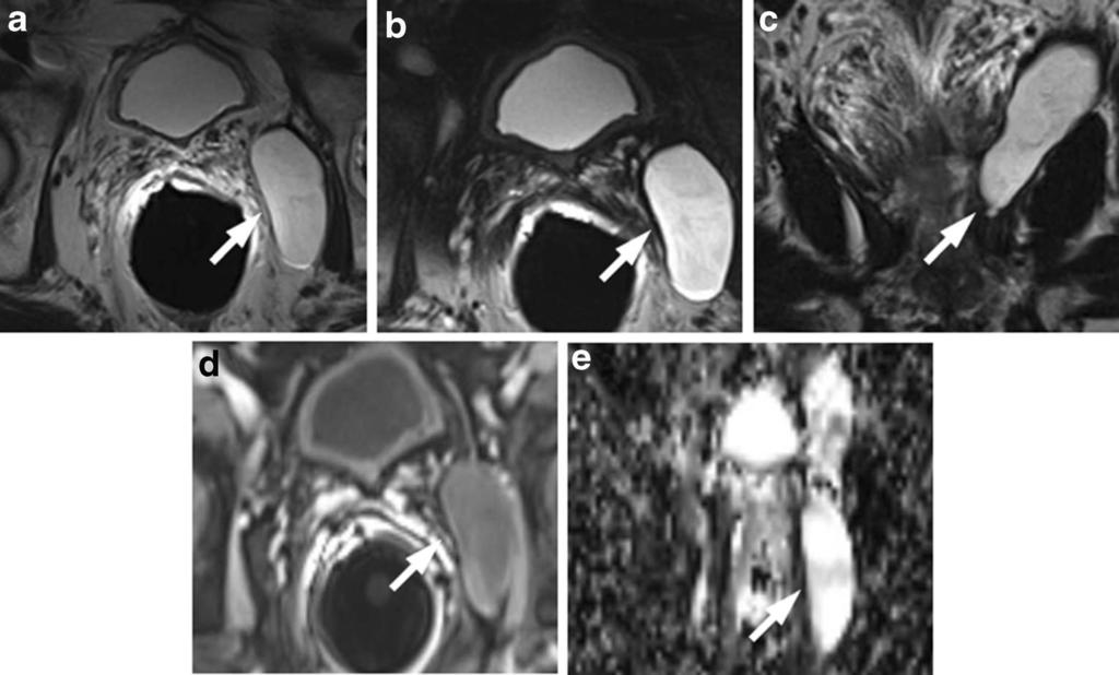 628 Insights Imaging (2015) 6:611 630 Fig. 25 Post-biopsy haemorrhage in the midgland of a 69-year-old man with a PSA serum level of 4.7 ng/ml.