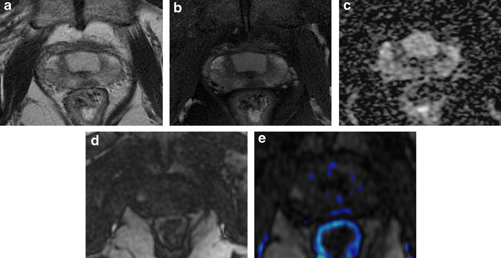 Insights Imaging (2015) 6:611 630 615 Fig. 3 Median posterior hypointense area at the middle third of the gland with no ERC.