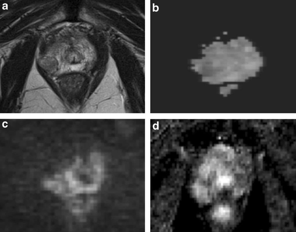 sharply defined nodule of low signal intensity surrounded by a pseudocapsule in the peripheral zone of the prostate at the right peri-apical location.