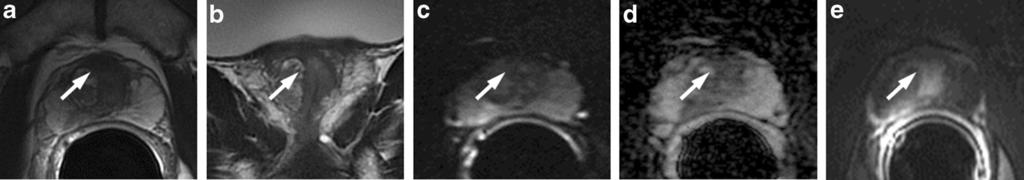 instillation of BCG (white arrows). c ADC map showing high restricted diffusion phenomena of water molecules in the hypointense posterior area detected on T2-weighted images.