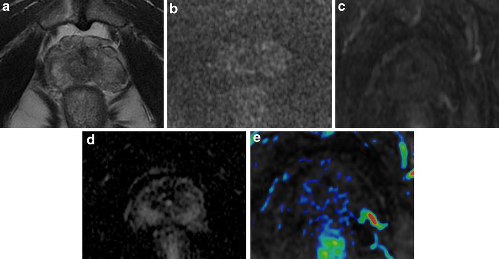 618 Insights Imaging (2015) 6:611 630 Fig. 9 Prominent peri-prostatic bundle with no ERC.