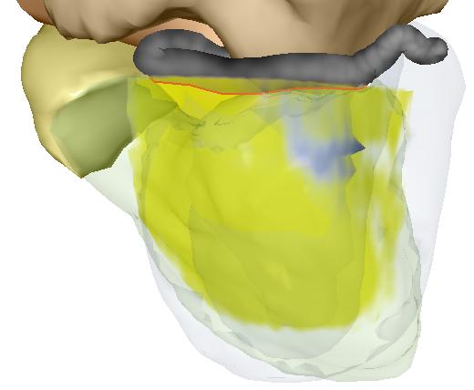 The combination of volume rendering with CPR has been presented before [13]. An initial orientation of the surface used for the CPR is computed using the long axis extracted from the heart model.