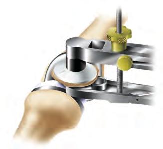 Implantation Patellar implantation 1 Assemble the patellar cement clamp to the patellar reamer guide. Clamp 2 Apply bone cement to the patella.
