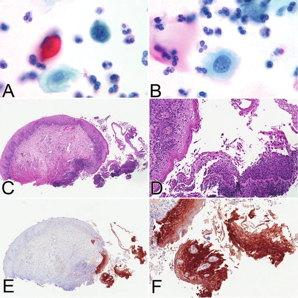 Figure 4. Papanicolaou (Pap) test and biopsy findings of a case interpreted as cervical intraepithelial neoplasia grade 2 after p16 staining.