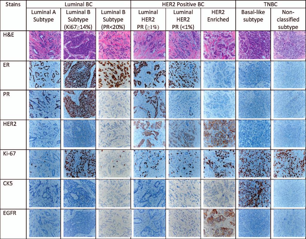 Samples of hematoxylin-eosin (H&E) and immunohistochemical patterns for 7 molecular subtypes.