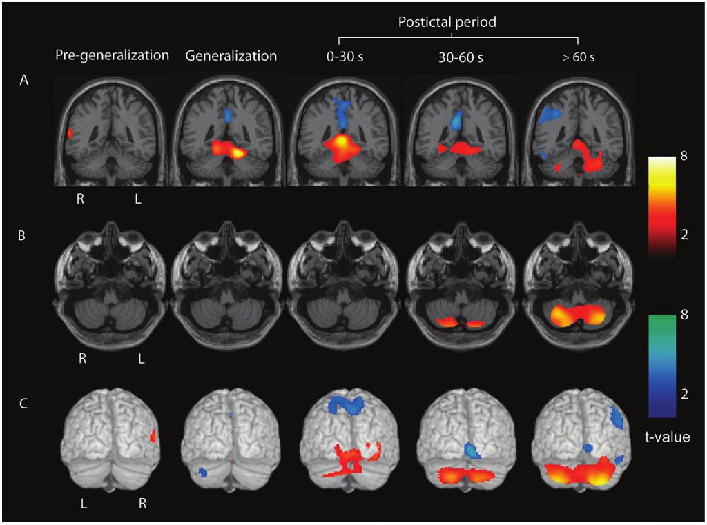 1008 Brain 2009: 132; 999 1012 H. Blumenfeld et al. Figure 6 Evolution of cerebellar CBF increases from the superior medial cerebellum to the lateral cerebellar hemispheres.